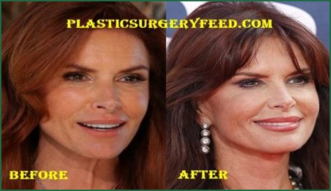 Roma Downey Plastic Surgery Before and After